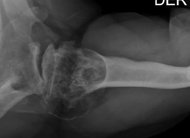  LADERA SUR. Osteonecrosis disbárica: la silenciosa enfermedad que corroe los huesos de los buzos salmoneros al sur de Chile